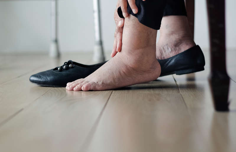 a close up of a persons feet: Beyond the big toe, gout pain and swelling can also take hold in other joints, with ankles and knees being common culprits. Overall, 84 per cent of people who have one gout attack have another attack within three years.