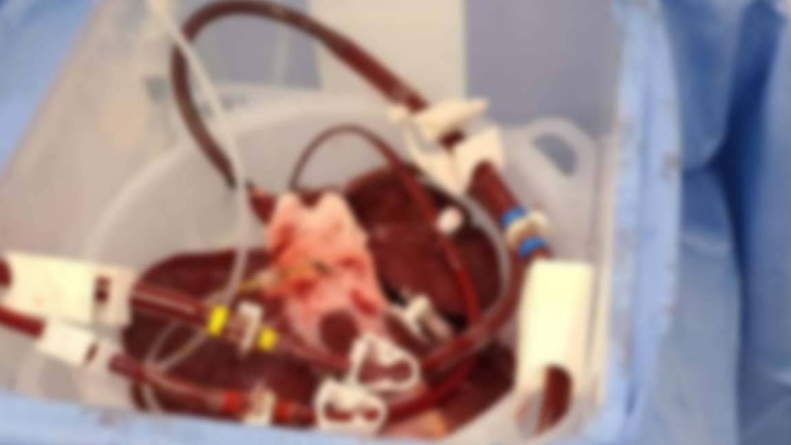 organ naklinde yeni umut: vücut dışında tutulan domuz karaciğeriyle insan kanı temizlendi
