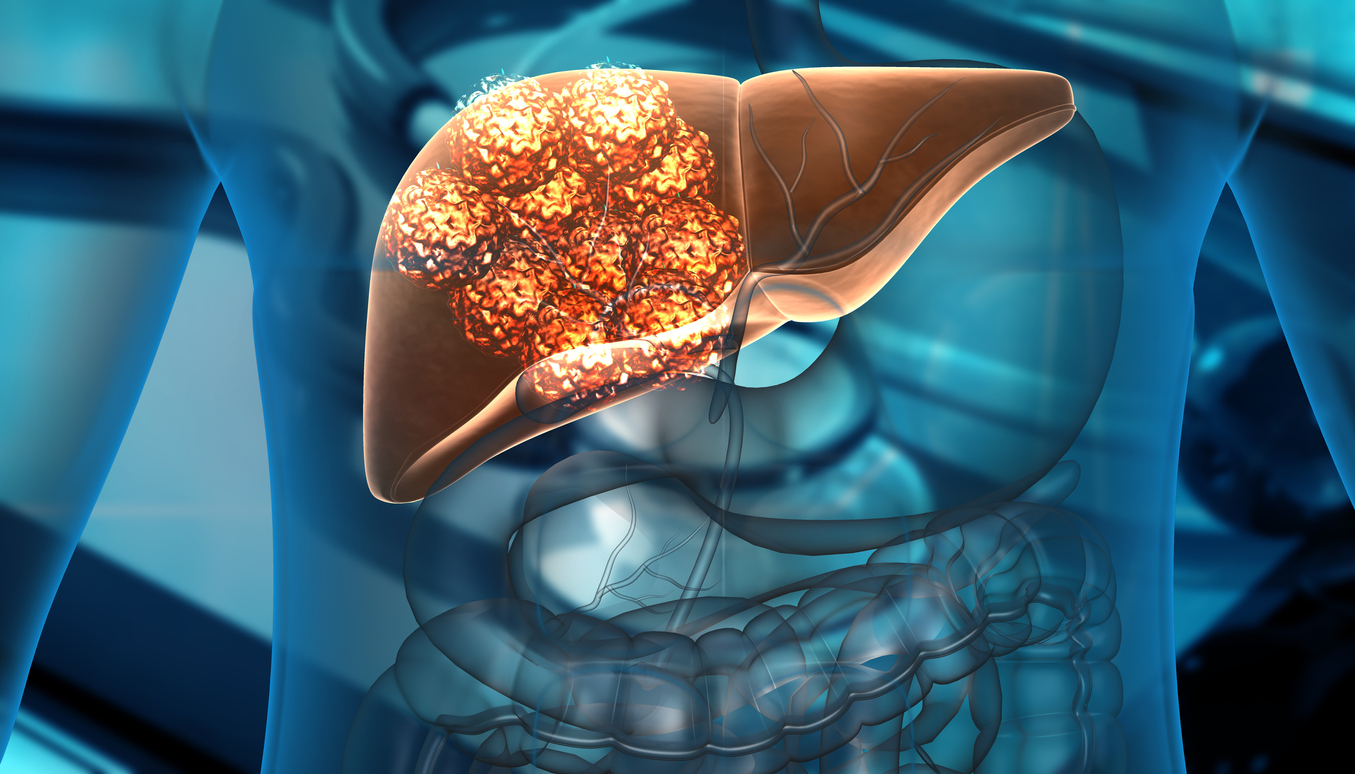 câncer no fígado: fique atento para não confundir sintomas com indigestão