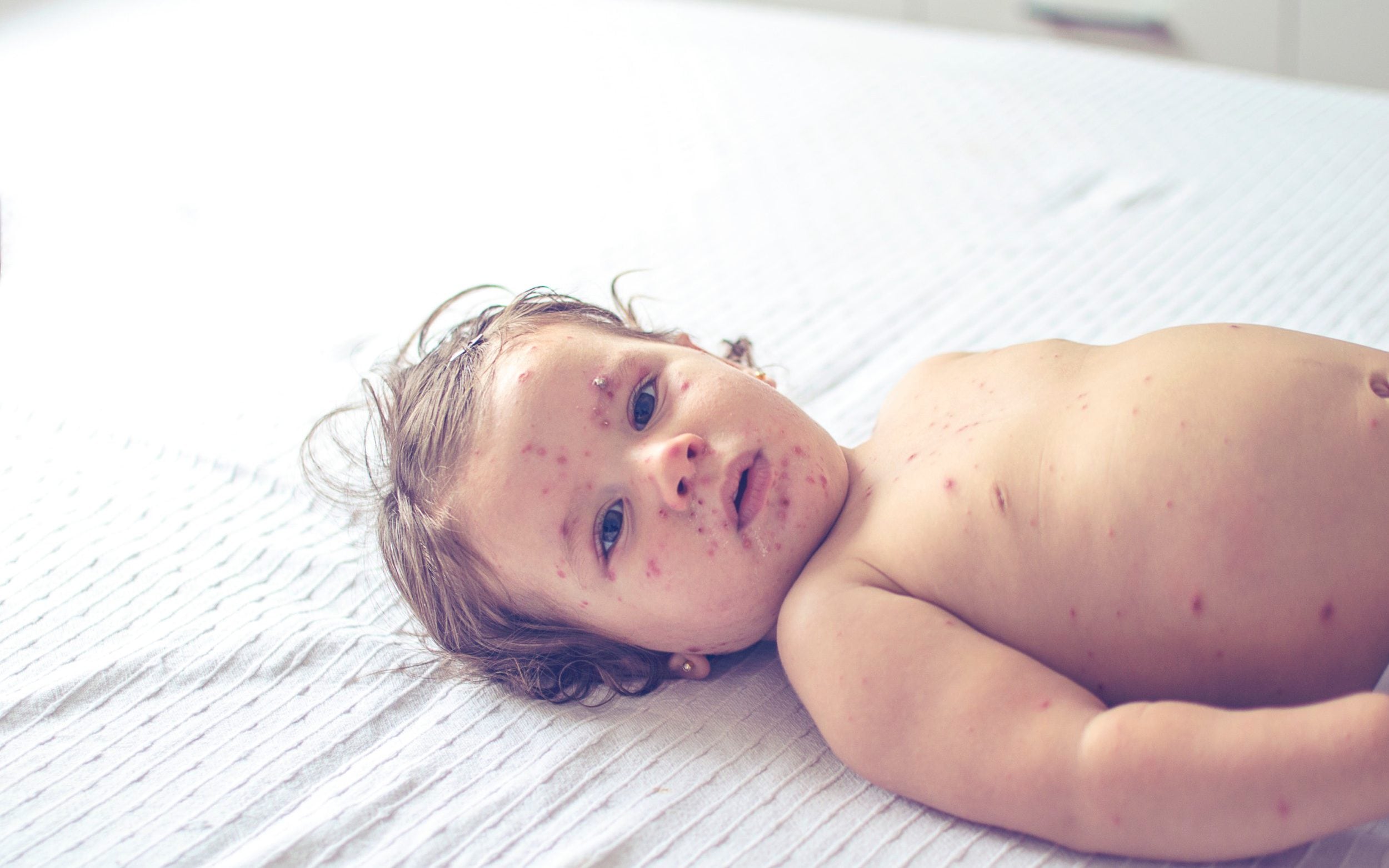 measles-how-to-spot-the-early-symptoms-and-keep-your-family-safe