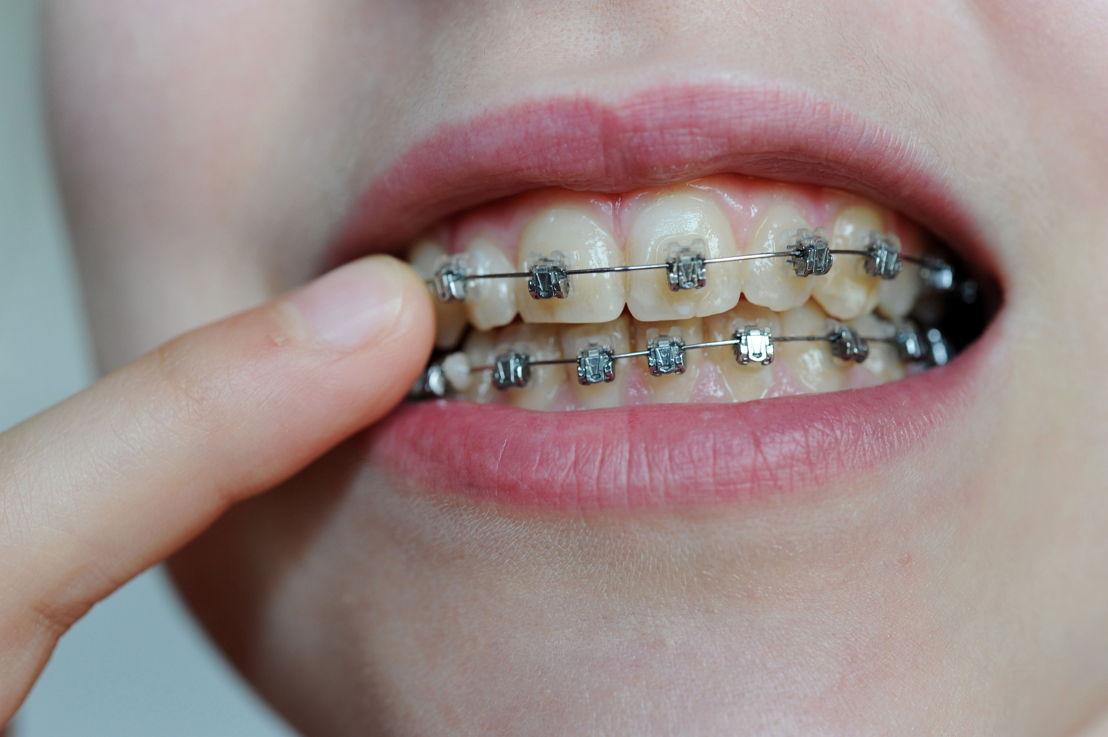 bruken av tannregulering hos barn øker med stigende inntekt