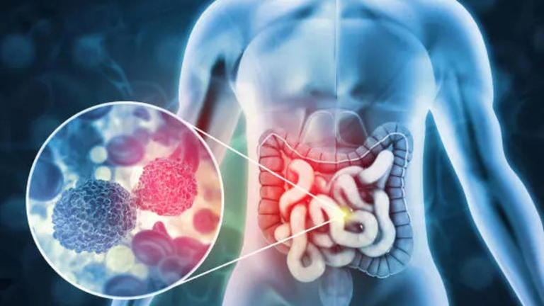 Why Is Bowel Cancer Mistaken For IBS? Doctor Shares Symptoms That Can Be Confusing