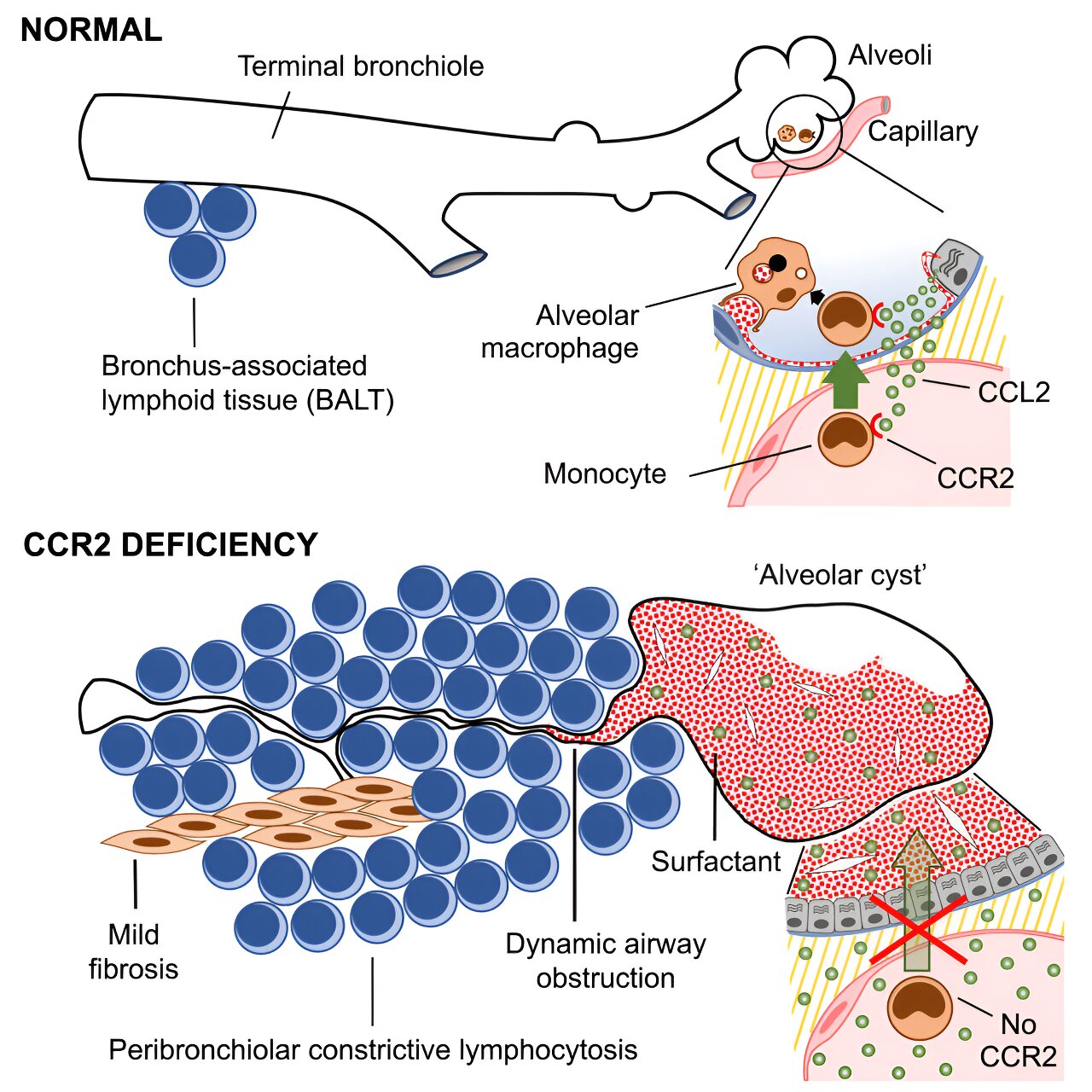 Newly Discovered Genetic Malfunction Causes Rare Lung Disease