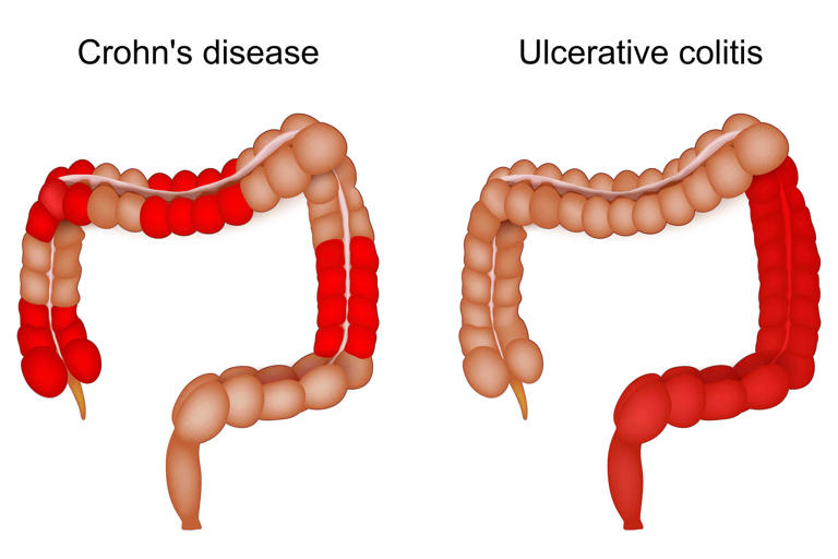 The Differences and Similarities Between Crohn's Disease and Ulcerative ...