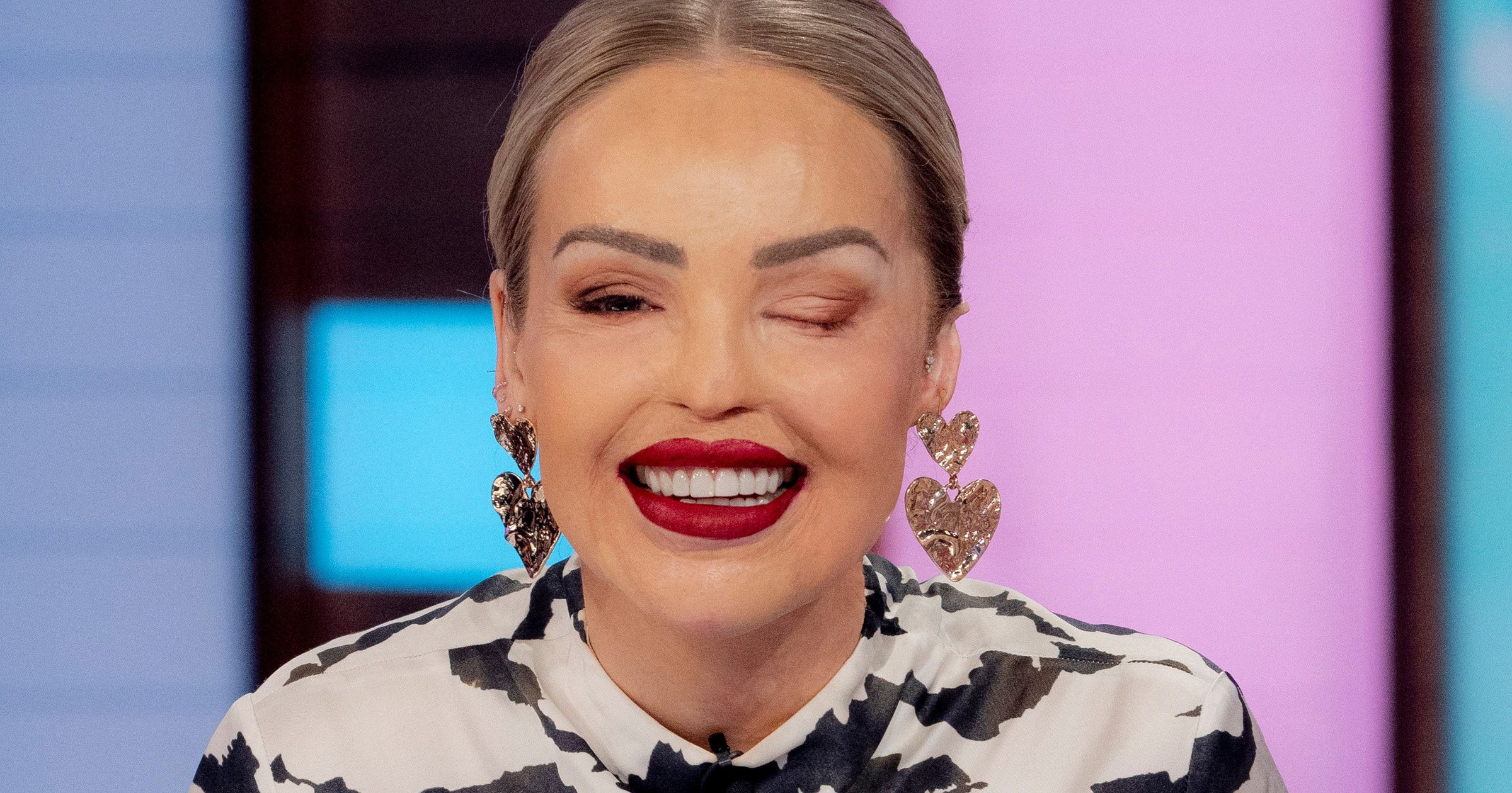 Katie Piper Unveils Dramatic New Look After Having Eye Sewn Shut   BB1hbKMV.img