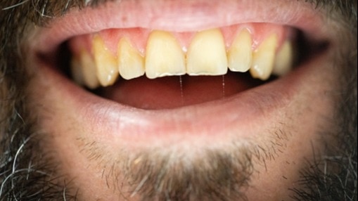 How to get rid of yellow teeth? It needs more than brushing