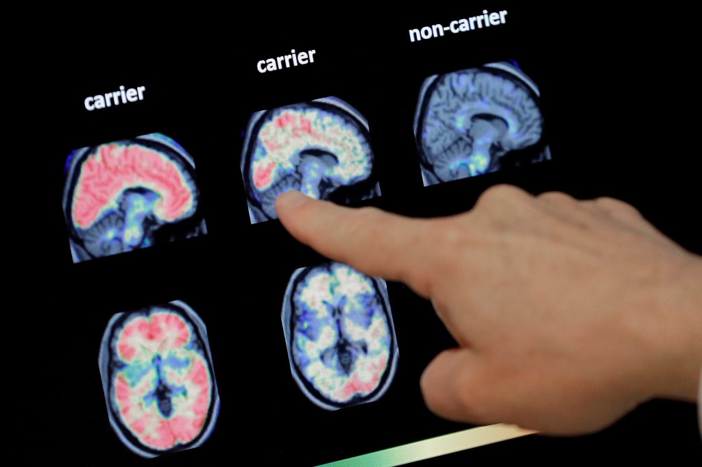 drug to treat agitation in alzheimer’s patients approved in canada