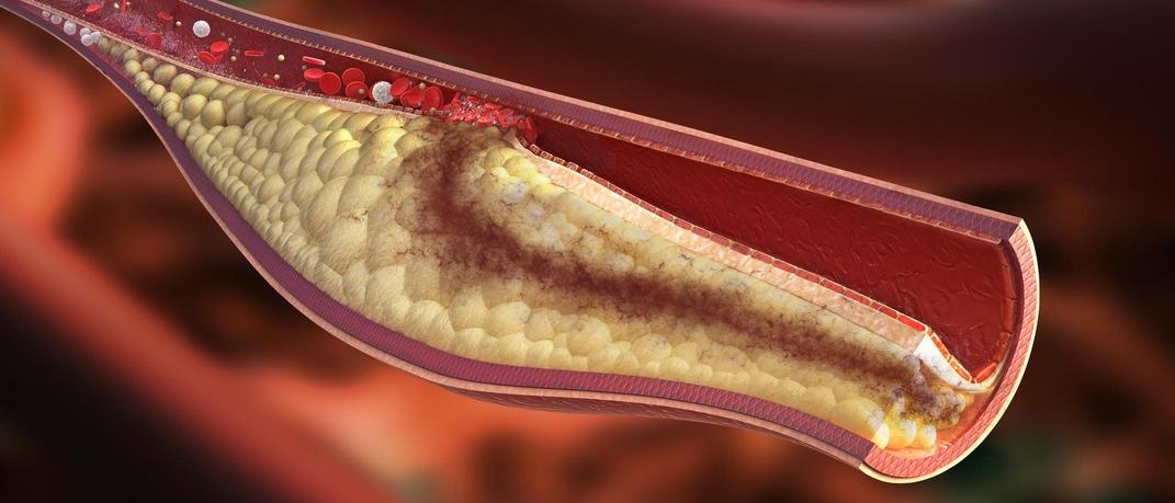 i nottambuli rischiano l’aterosclerosi delle arterie