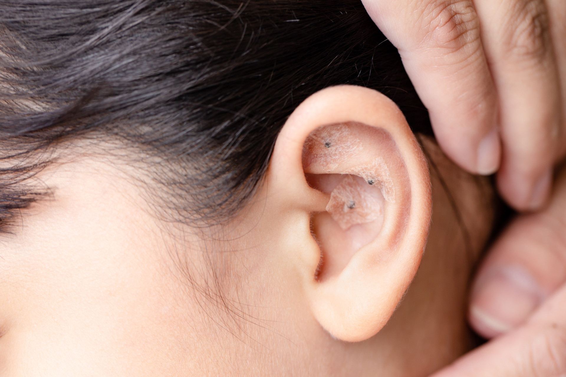 What Are Ear Seeds And How Do They Work