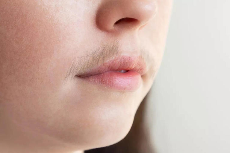 Home Remedies To Remove Facial Hair