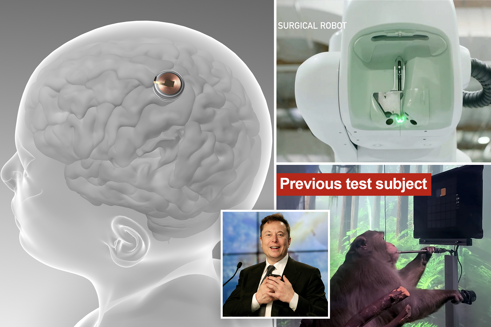 Elon Musk’s Startup Neuralink Implants Chip Into Brain Of First Human ...