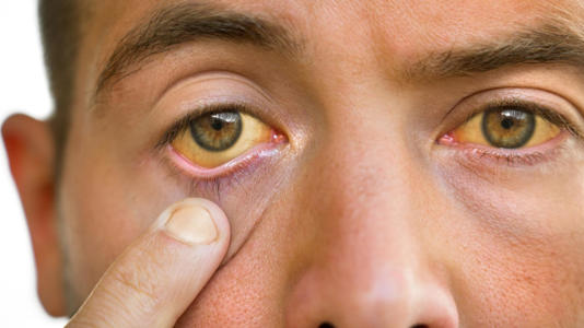 Pele e olhos amarelos podem ser sinais de um fígado danificado