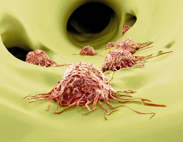 Scientists take the first step toward early diagnosis of metastasis ...