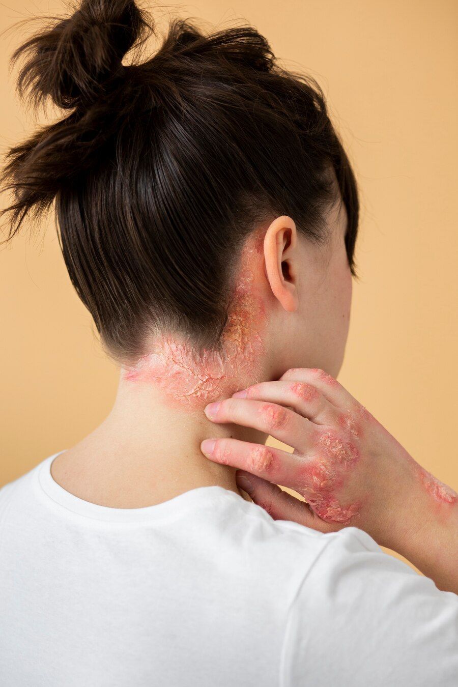 ¿cómo curar el sarpullido, según una experta en dermatología?