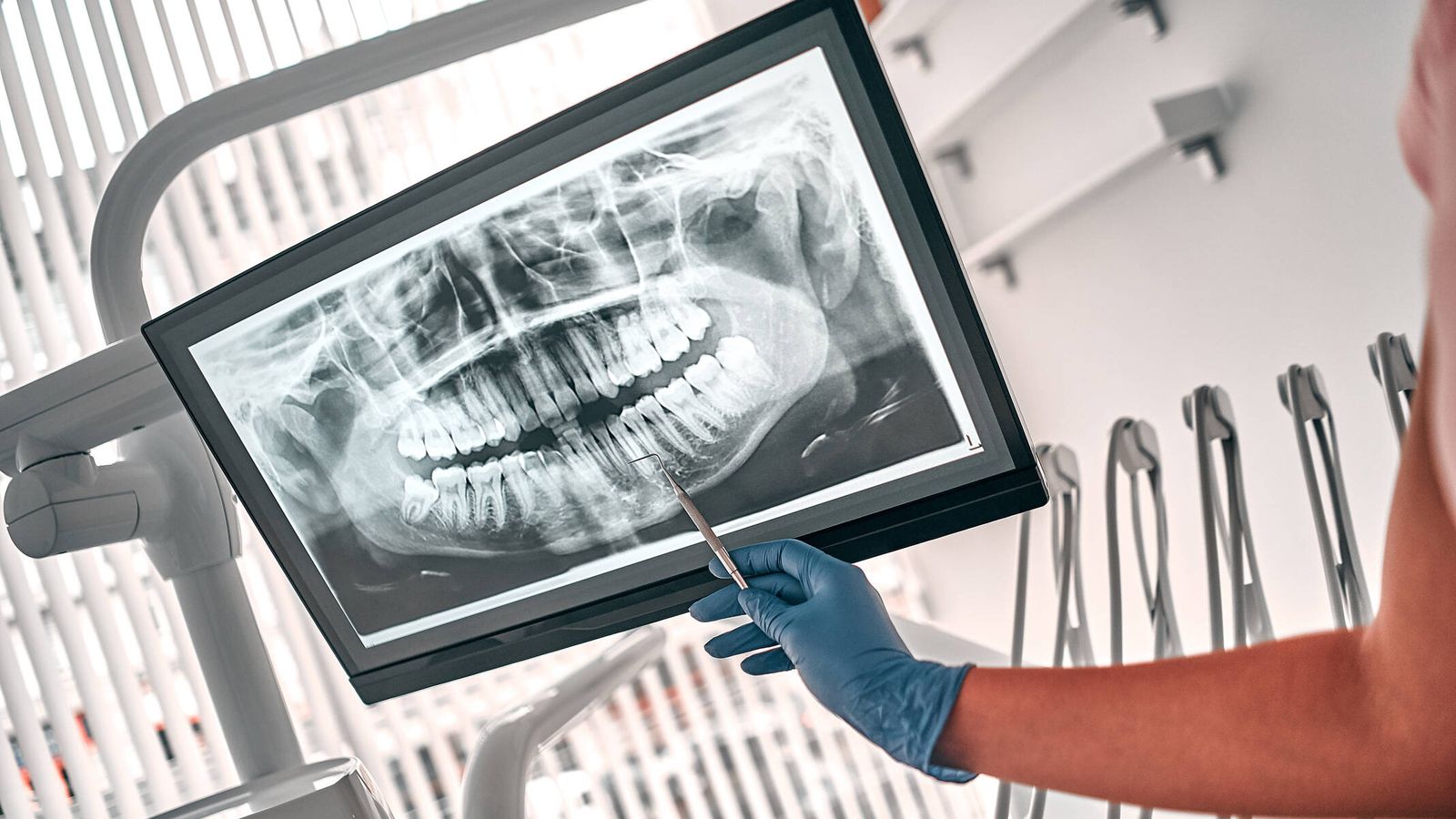 alerta para usuarios de sintrom: por qué no deben dejarlo antes de una intervención dental