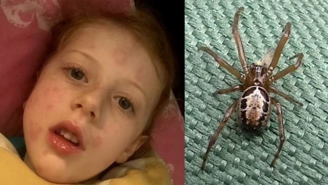 βρετανία: 5χρονη γέμισε εξανθήματα και δεν μπορούσε να περπατήσει από τσίμπημα αράχνης