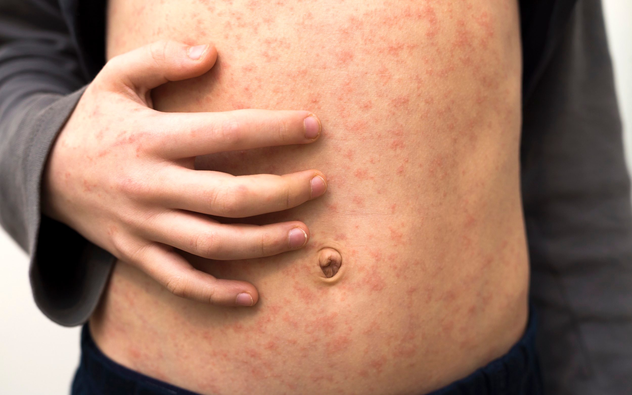 more than half of the world at ‘high’ risk of measles outbreaks, who warns