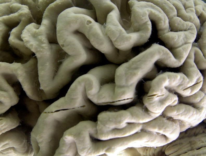silent brain changes precede alzheimer's. researchers have new clues about which come first