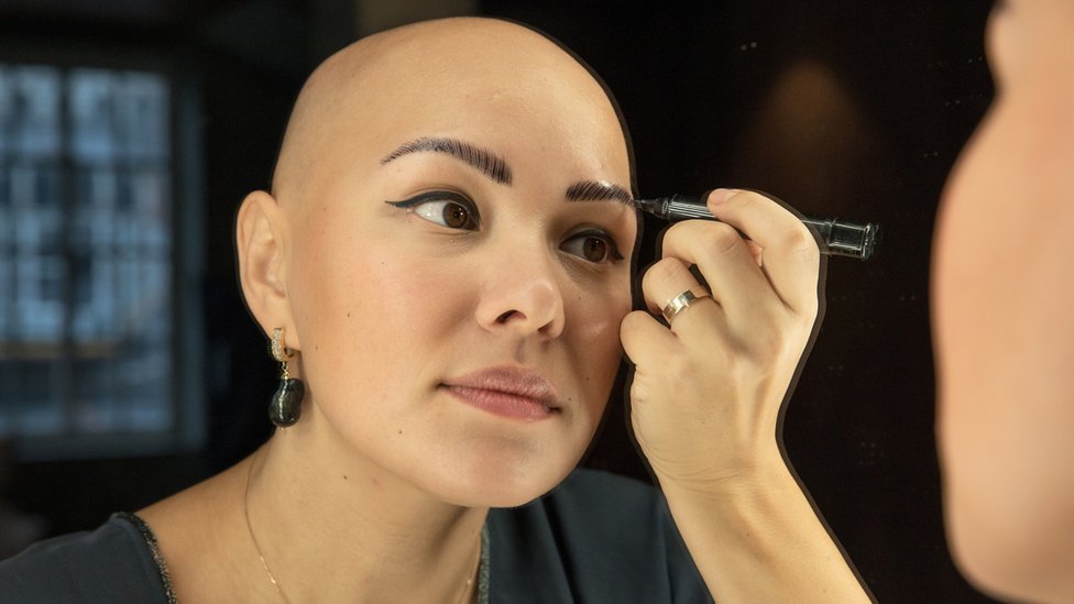 first alopecia treatment recommended on the nhs