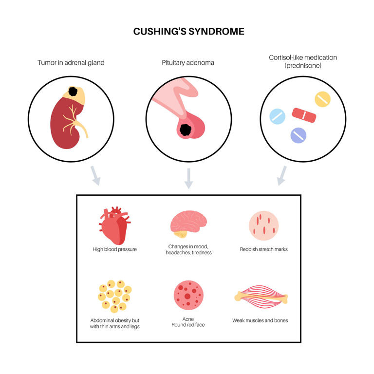 What is Cushing’s syndrome? Explaining Amy Schumer’s diagnosis