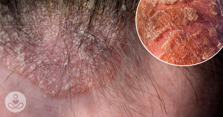 Scalp Eczema 8 Natural Remedies For Red Flaky Or Itchy Scalps