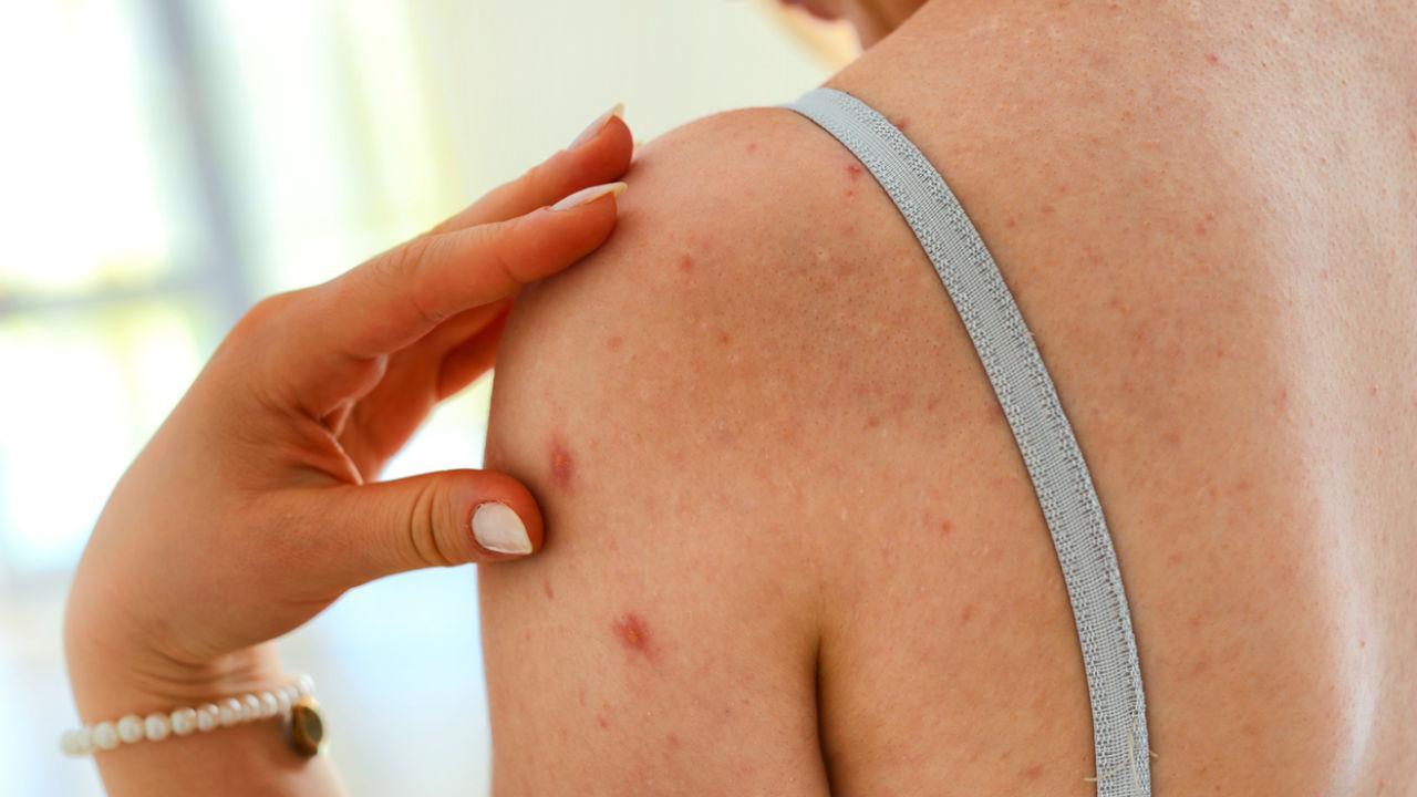 oms pede resposta urgente contra sarampo para proteger milhões de crianças na europa
