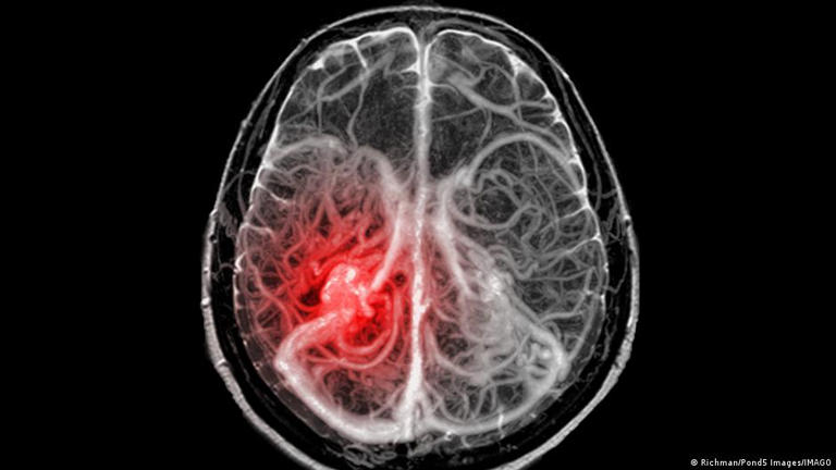 Imagen de archivo: escaneo del cerebro vía resonancia magnética para evaluar daño arterial