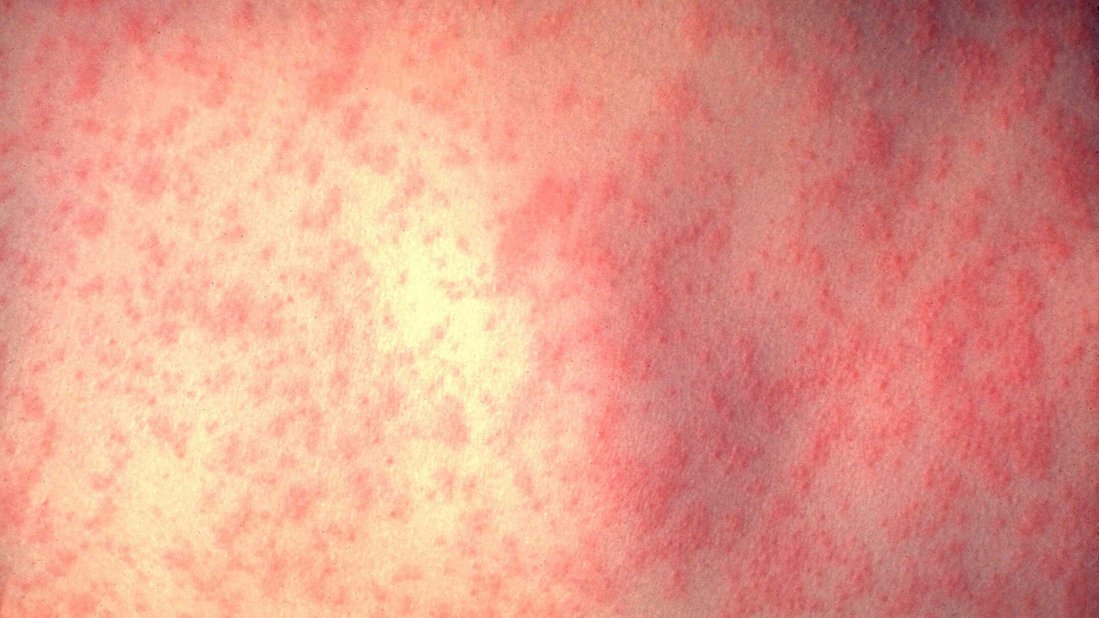 adelaide child reported with measles as cases emerge around australia