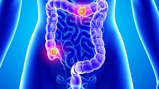 colorectal cancer symptoms: what you need to know