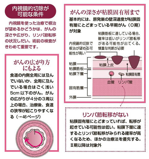 ごく早期の食道がんに効果的な、内視鏡を使ったがんの切除について徹底解説