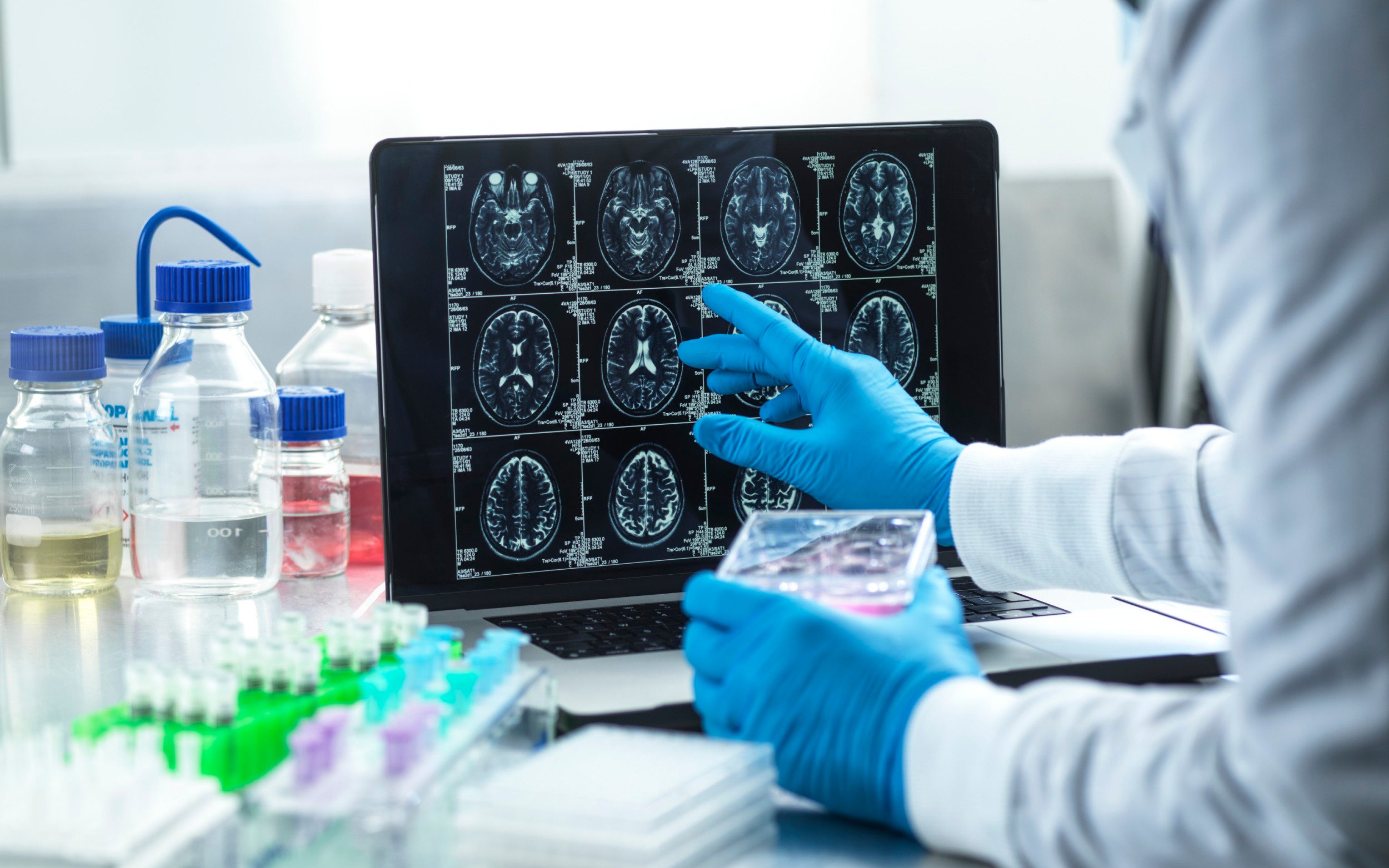 ‘breakthrough’ alzheimer’s drugs can shrink brain, scientists warn