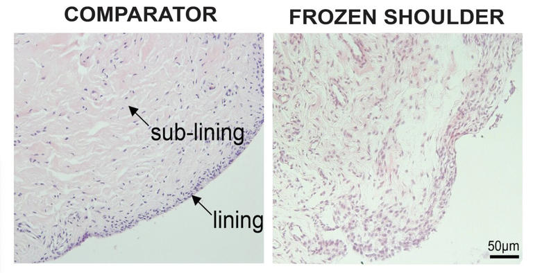 Tissue sections show frozen shoulder patient tissues exhibit an increased number of cells and blood vessels relative to non-diseased comparator shoulder capsule. Credit: Prof. Stephanie Dakin