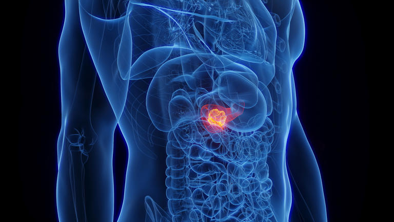 Pancreatic cancer is quite prevalent in India, and it is considered to be the 11th most common type of cancer in the country.Â (Photo: Getty Images)