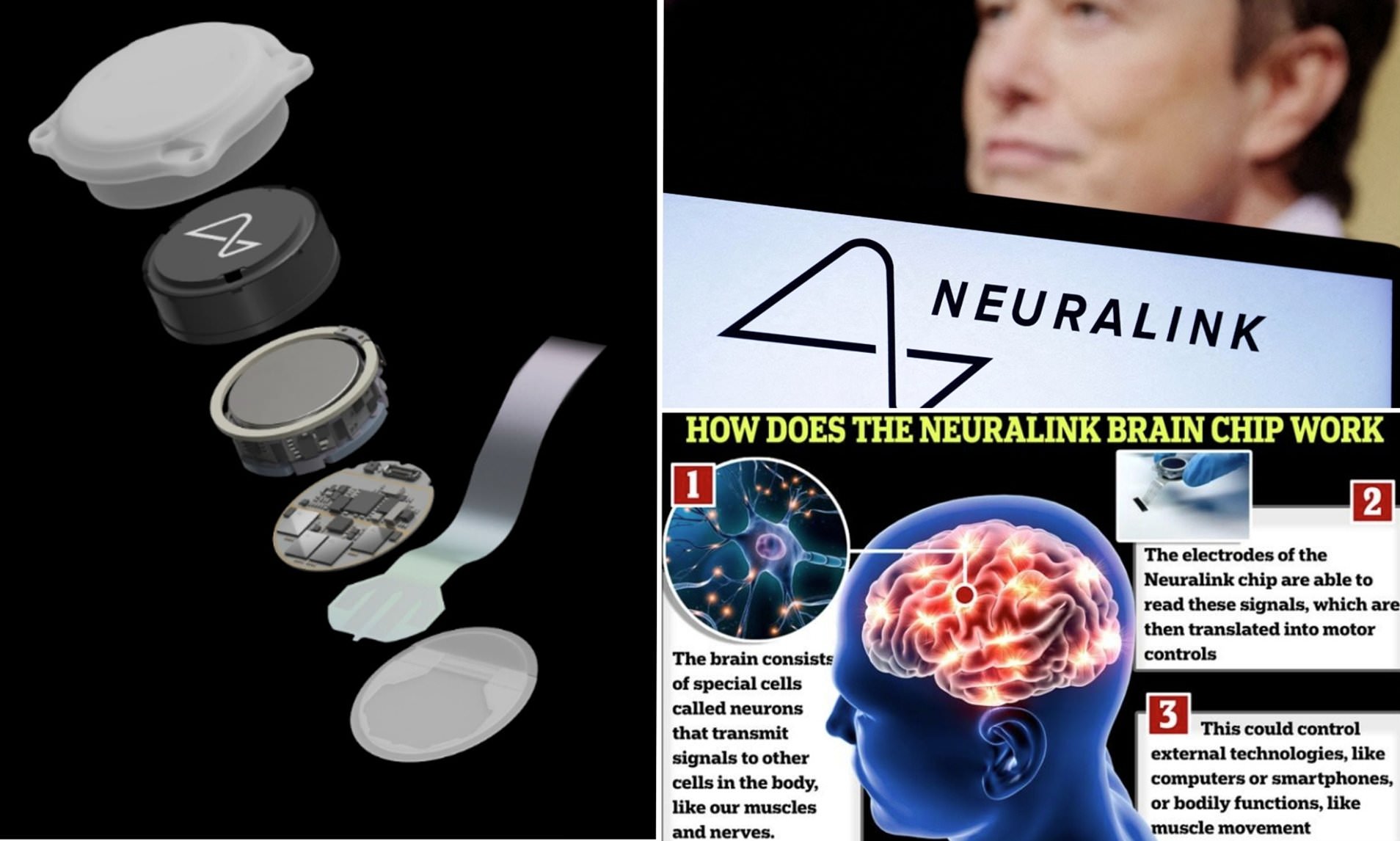 Elon Musk Says First Human Patient Implanted With A Neuralink Brain ...