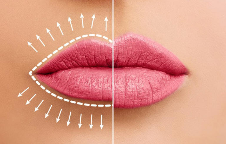 4 Solutions for Thin Lips