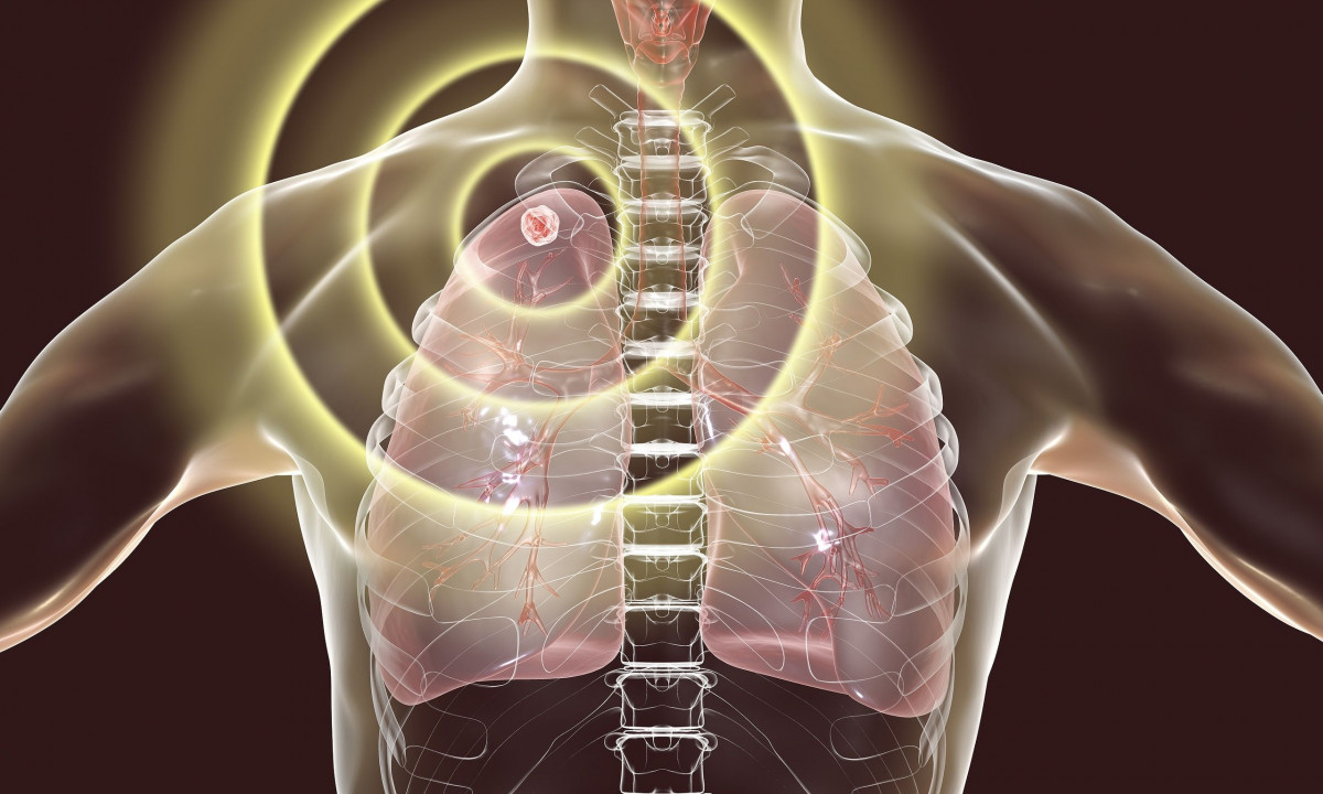 πνευμονικοί όζοι: συμπτώματα – πότε είναι καλοήθεις