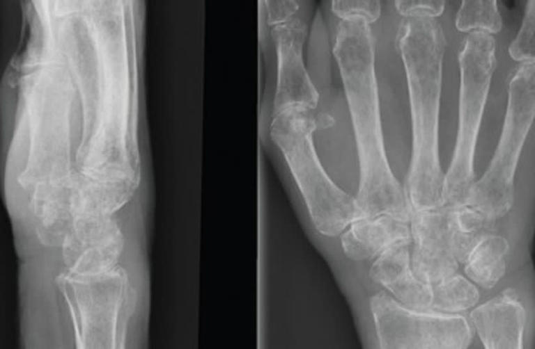  Radiografía de los huesos del esqueleto de la mano 390 (credit: Wikimedia Commons)