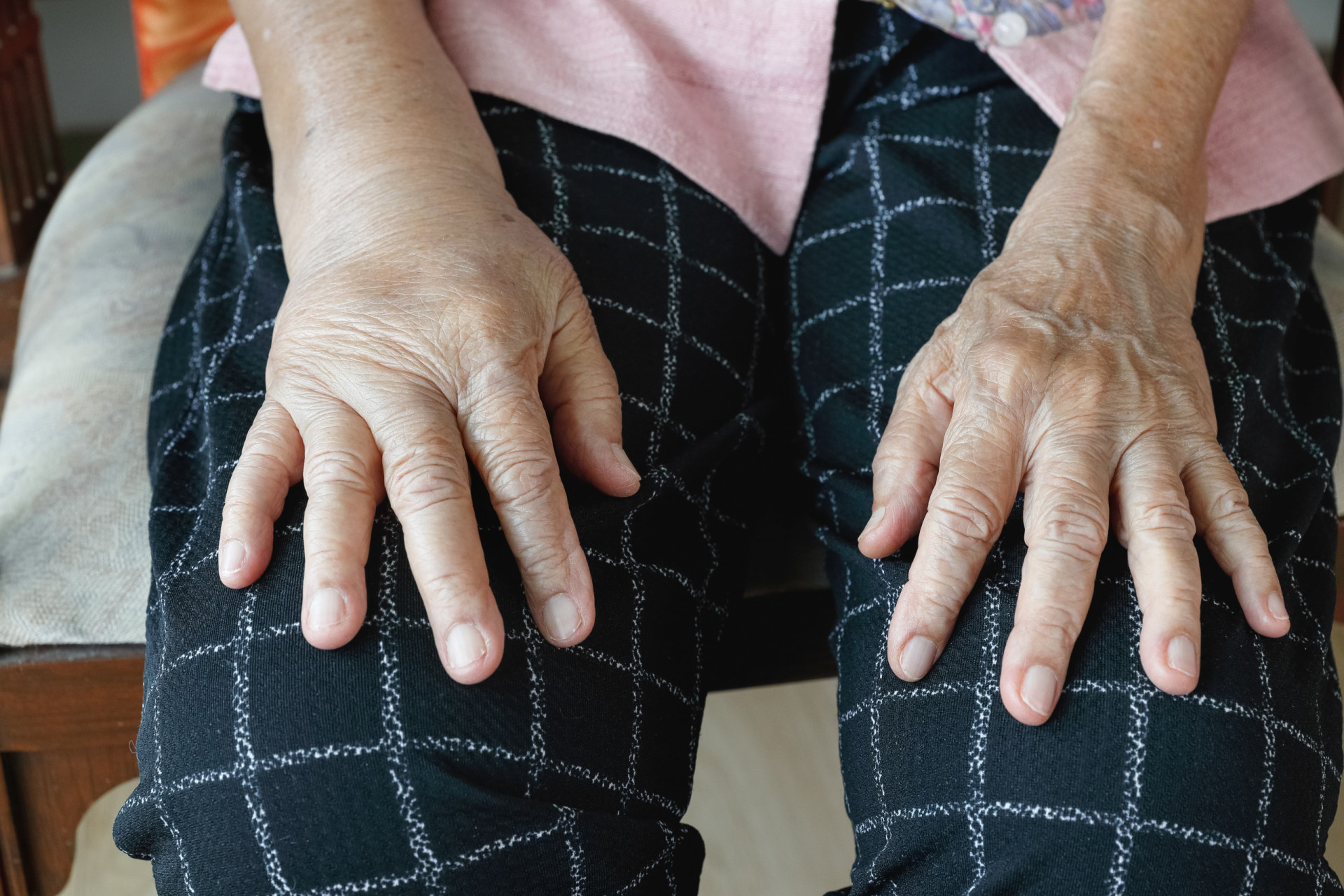 Everything you need to know about edema