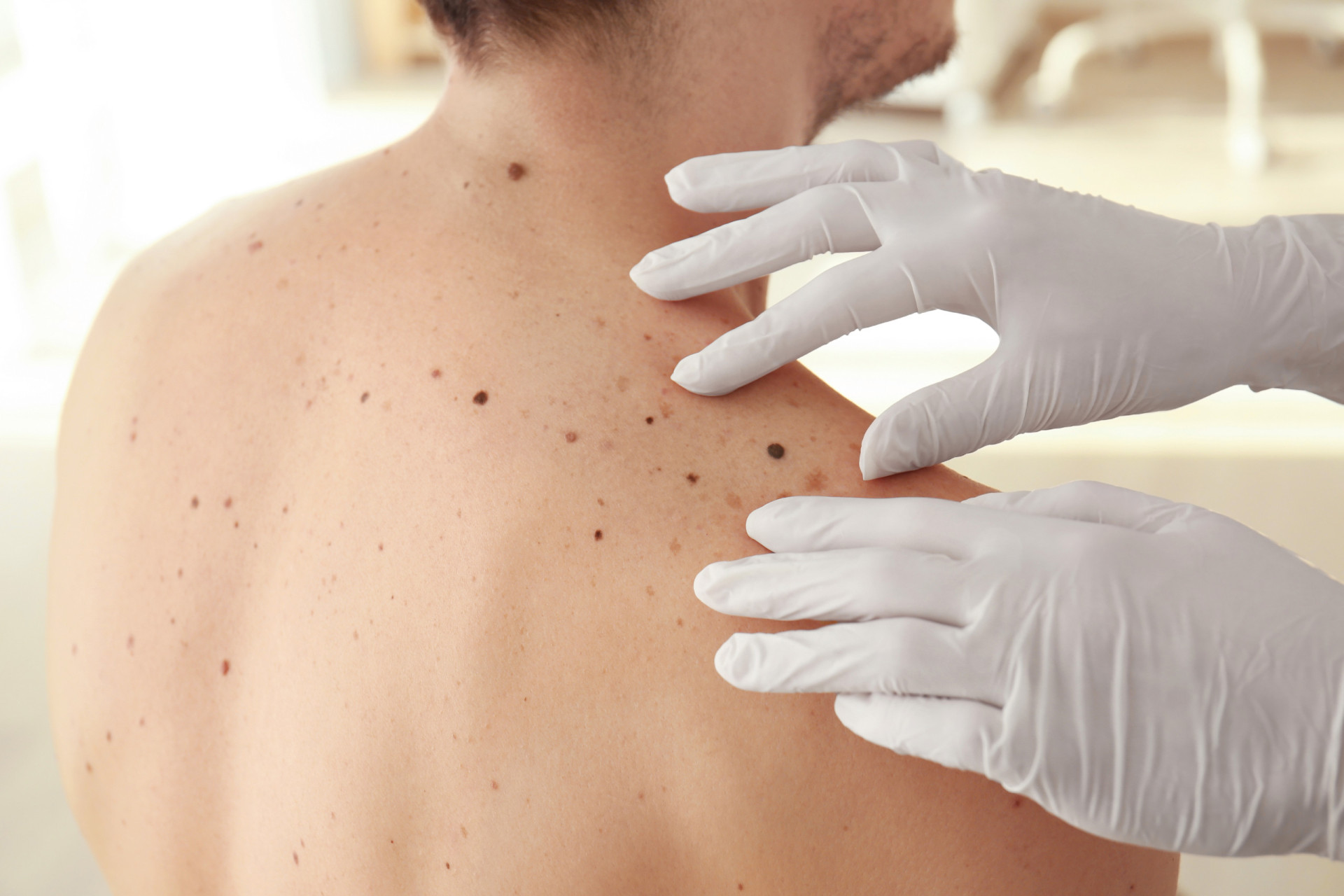 Skin cancer: everything you need to know