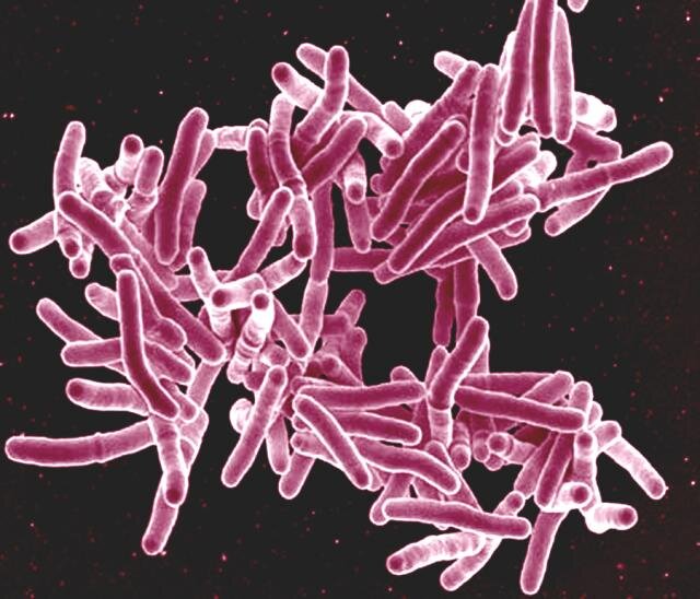 Ultrasensitive test reveals evidence of previously undetected tuberculosis in hospital patients<br><br>
