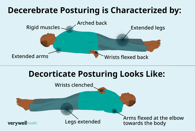 What Is Decerebrate Posturing?