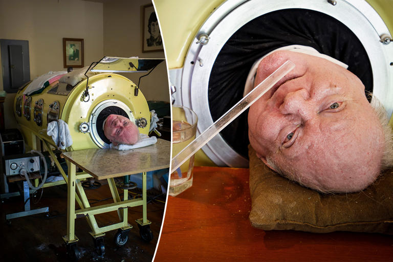 ‘Polio Paul’ Alexander, who spent 72 years inside iron lung, dead at 78