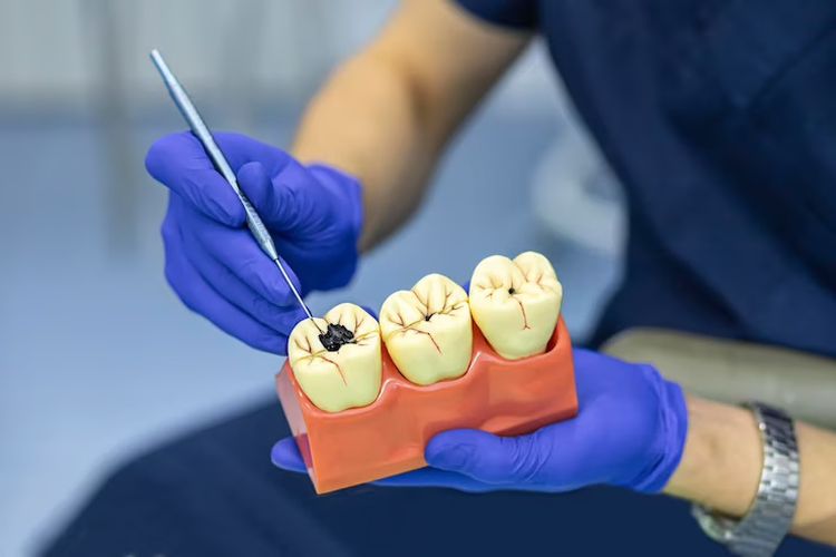 inilah 5 gejala gigi berlubang yang berbahaya, wajib diperhatikan