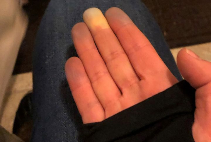 Raynaud's Disease: Causes, Symptoms, and Key Insights