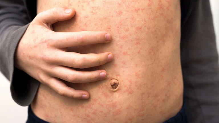 Measles outbreak puts elimination status at risk: CDC