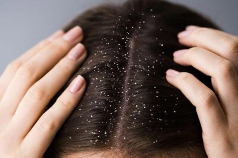 Watch: Ayurveda Expert Shares Easy DIY Anti-dandruff Mask