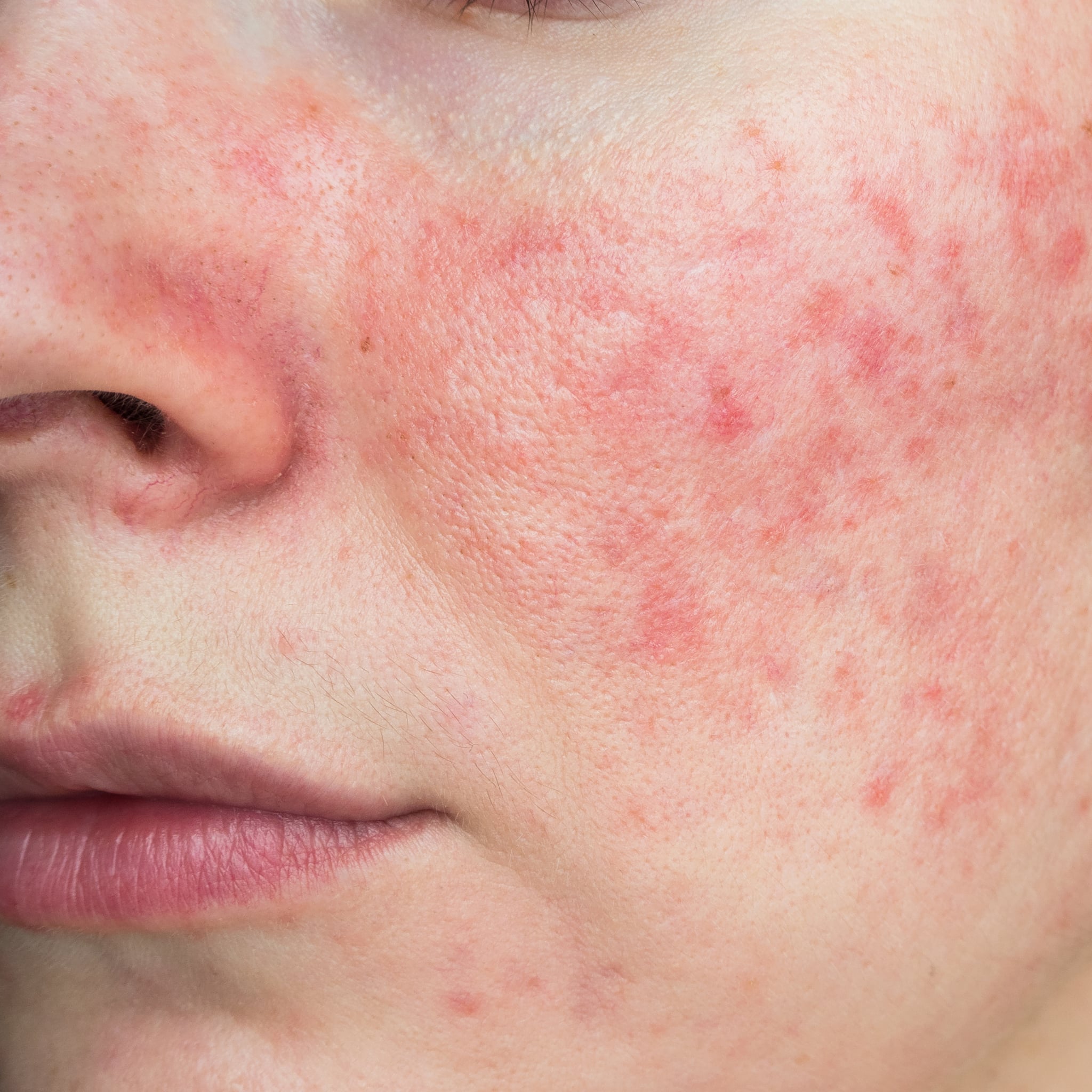 The Best Rosacea Skin-care Routine, According To Experts