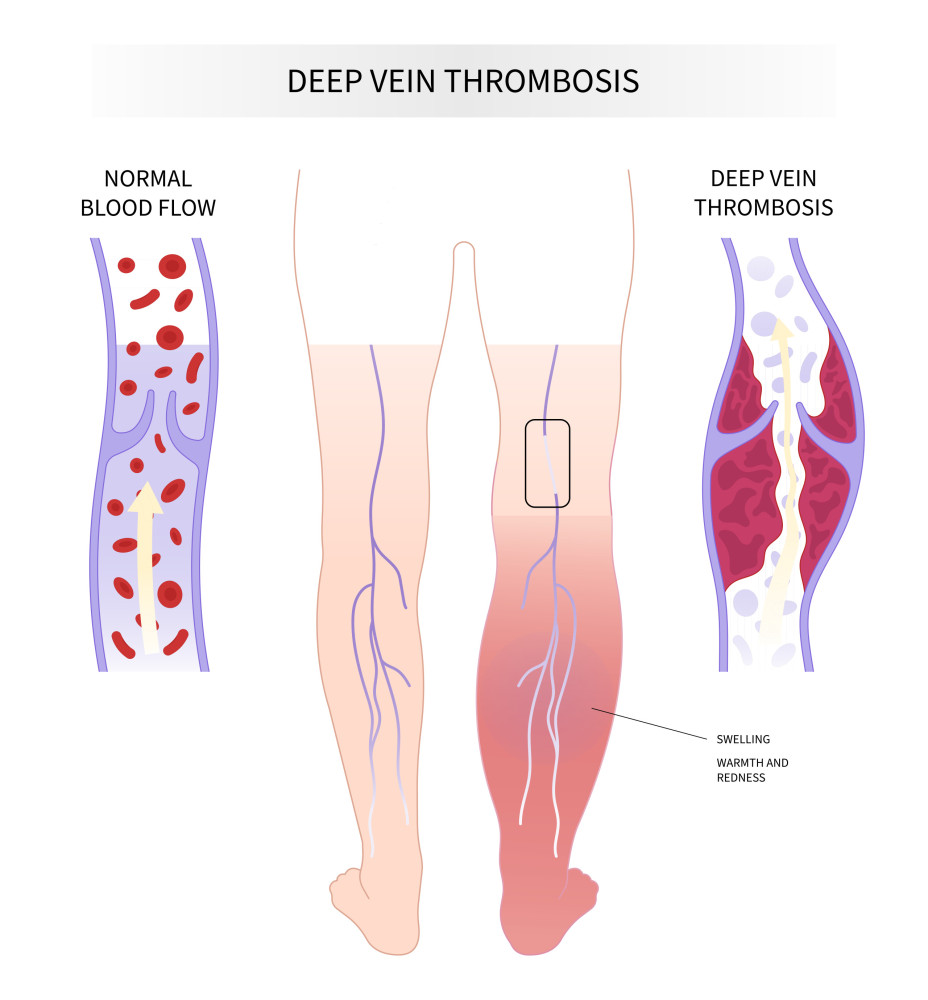 What exactly is Hughes syndrome?