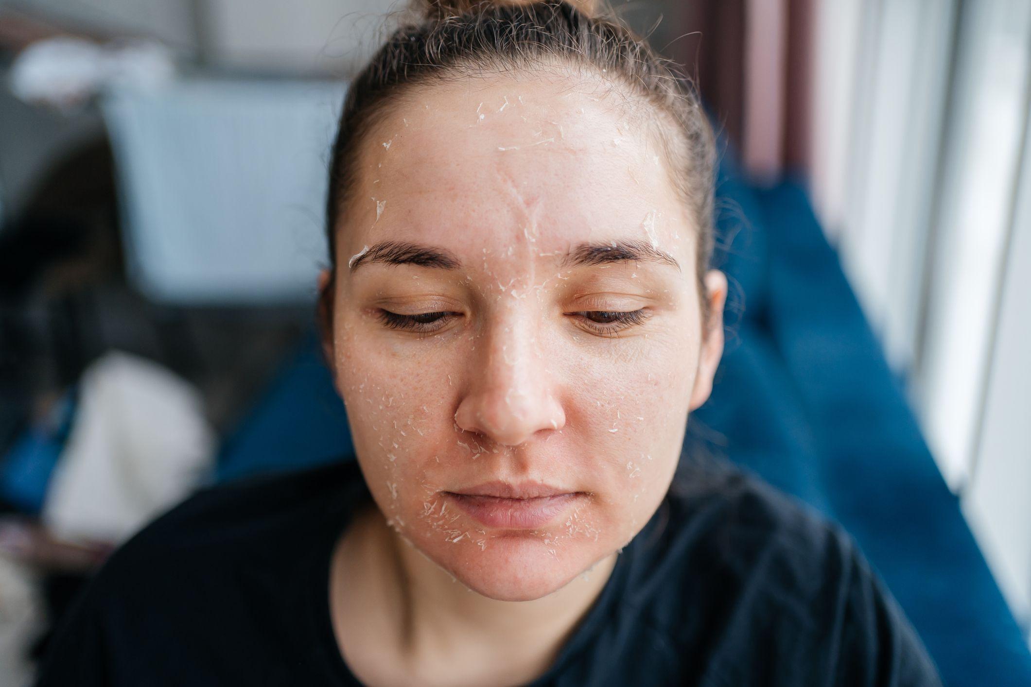 o que aprendi em minha desesperada busca por solução para acne severa