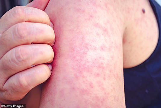 Measles typically begins with cold-like symptoms, before causing a rash made up of small red spots, some of which can feel slightly raised. According to the NHS, it typically starts on the face and behind the ears before spreading further